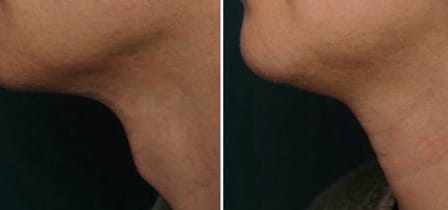Tracheal shave before and after (2)