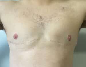 After Image: FtM TOp Surgery Revision with Conversion to DI and Nipple Grafts