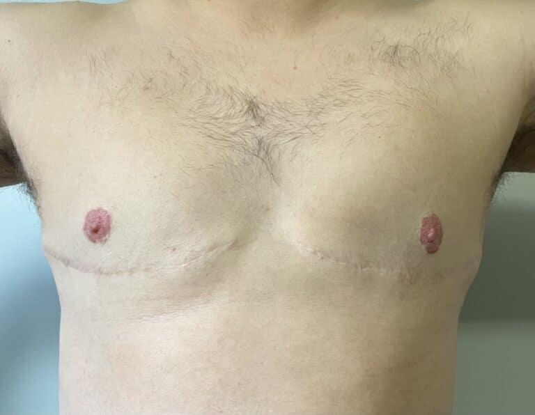 After Image: FtM TOp Surgery Revision with Conversion to DI and Nipple Grafts - front