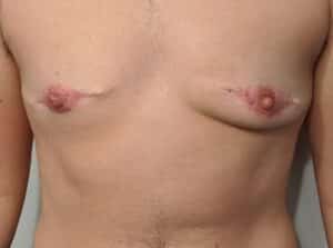 Before Image: FtM TOp Surgery Revision with Conversion to DI and Nipple Grafts