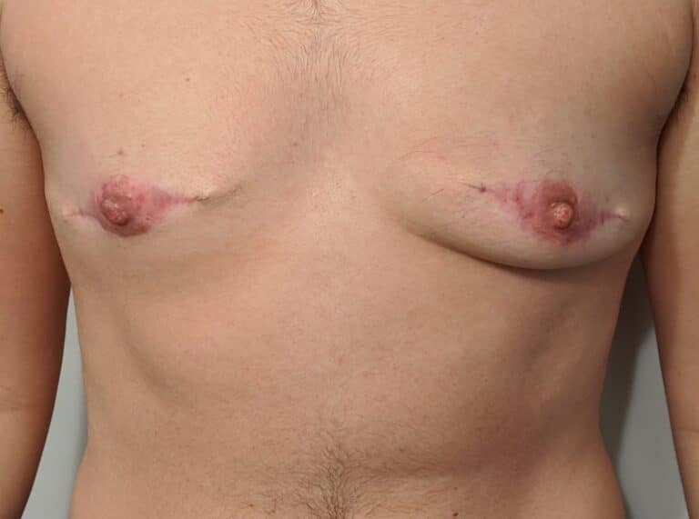 Before Image: FtM TOp Surgery Revision with Conversion to DI and Nipple Grafts - front