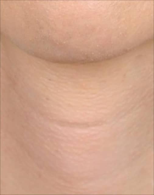 tracheal shave 5 after
