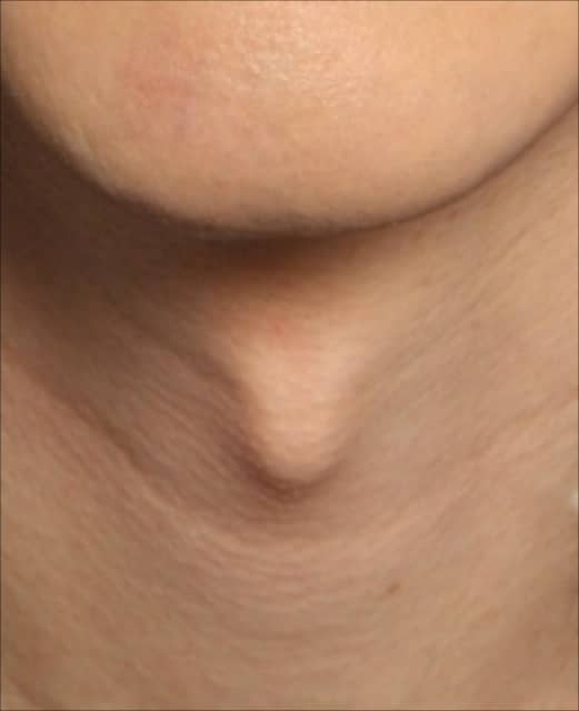 tracheal shave 5