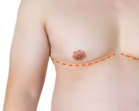 double incision top surgery
