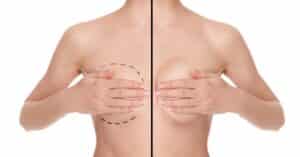 Before and after photo collage of woman showing results of breast augmentation with silicone implants on white background