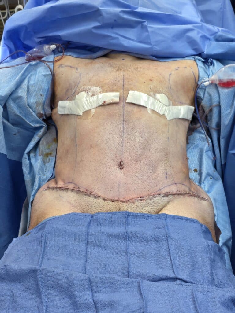 Di and tummy tuck after