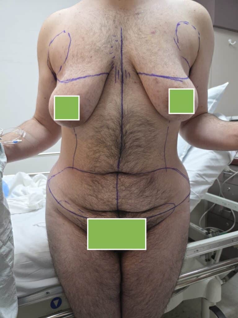Di and tummy tuck before