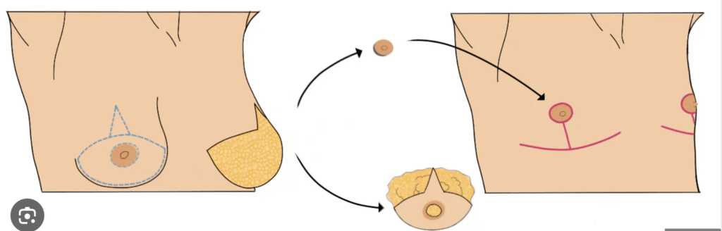 Inverted T anchor mastectomy for FtM Top Surgery