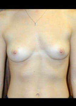 Before Image: Breast Augmentation - front