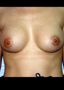 After Image: Breast Augmentation - front