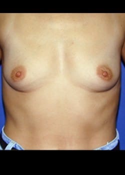Before Image: Breast Augmentation - front