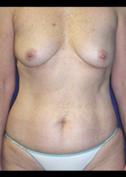 Before Image: Mommy Makeover - front