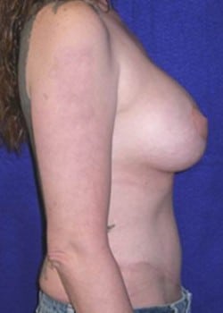 After Image: Mommy Makeover - right-side