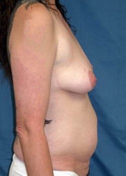 Before Image: Mommy Makeover - right-side