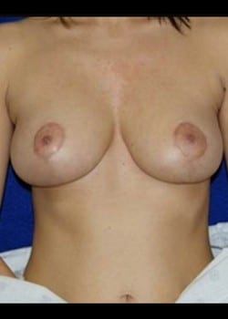 After Image: Breast Lift - front