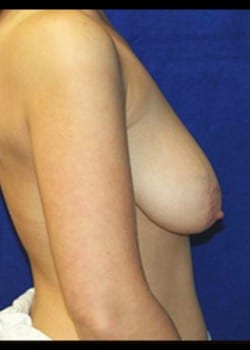Before Image: Breast Lift - right-side