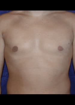 After Image: Gynecomastia reduction - front