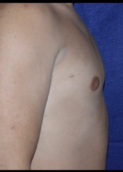 After Image: Gynecomastia reduction - right-side