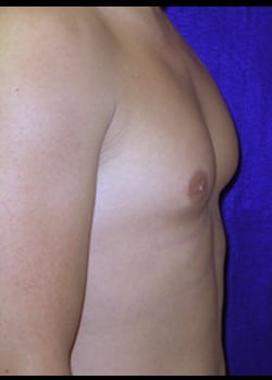 Before Image: Gynecomastia reduction - right-side