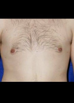 After Image: Male breast reduction - front