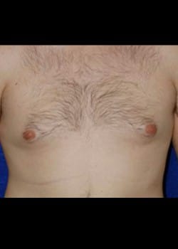 Before Image: Male breast reduction - front