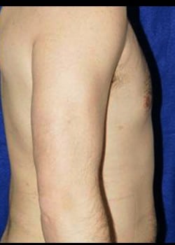 After Image: Male breast reduction - right-side