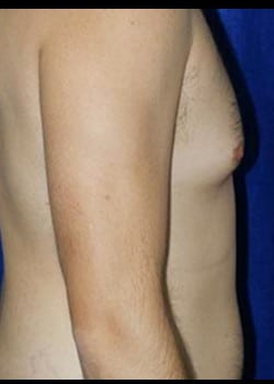 Before Image: Male breast reduction - right-side
