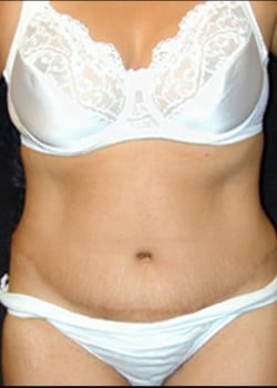 After Image: Abdominoplasty - front