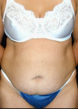 Before Image: Abdominoplasty - front
