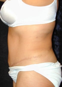 After Image: Abdominoplasty - left-side