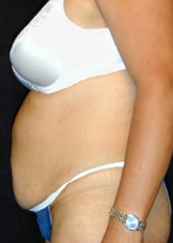 Before Image: Abdominoplasty - left-side
