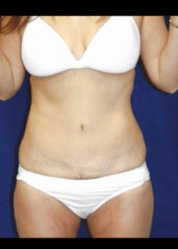 After Image: Abdominoplasty - front