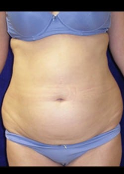 Before Image: Abdominoplasty - front