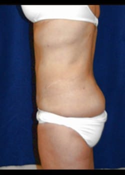 After Image: Abdominoplasty - left-side