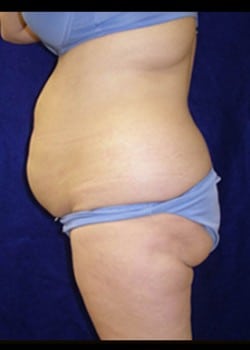 Before Image: Abdominoplasty - left-side