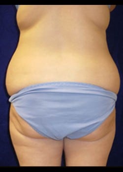 Before Image: Abdominoplasty - back