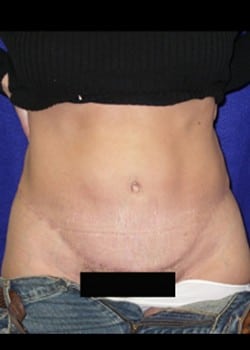 After Image: Abdominoplasty - front