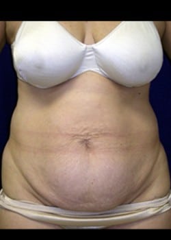 Before Image: Abdominoplasty - front