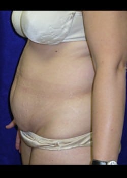 Before Image: Abdominoplasty - left-side