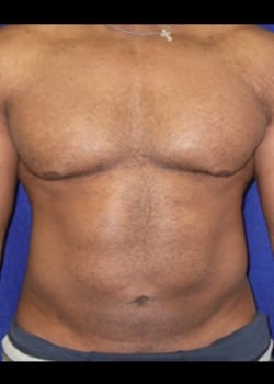 After Image: Liposuction - front
