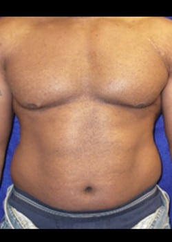 Before Image: Liposuction - front