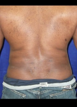 After Image: Liposuction - back
