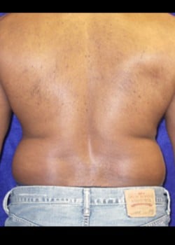 Before Image: Liposuction - back