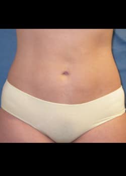 After Image: Liposuction - front