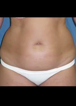 Before Image: Liposuction - front