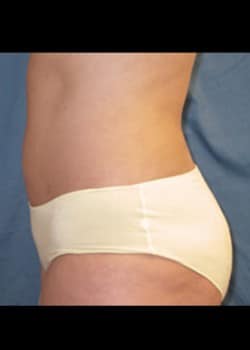 After Image: Liposuction - left-side