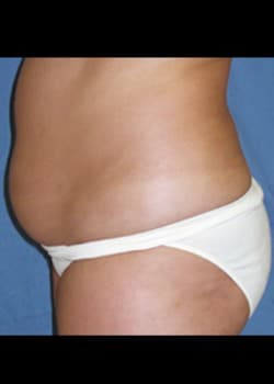 Before Image: Liposuction - left-side