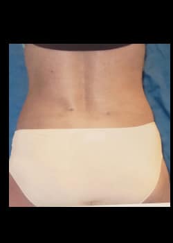 After Image: Liposuction - front