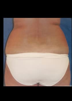 Before Image: Liposuction - front