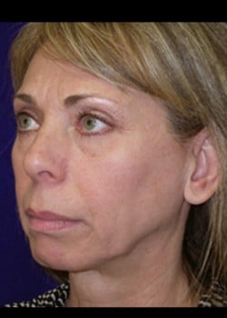 Before Image: Facelift - right-front-oblique